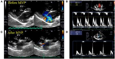 Measurement of Pulmonary Artery Wave Reflection Before and After Mitral Valvuloplasty in Canine Patients With Pulmonary Hypertension Caused by Myxomatous Mitral Valve Disease